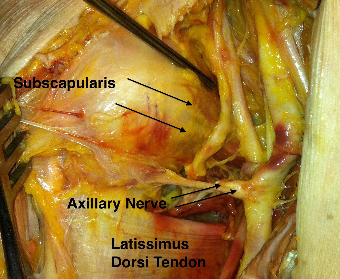 Anterior shoulder approach